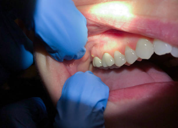 Best Emergency Tooth Extraction in Byrdstown, TN